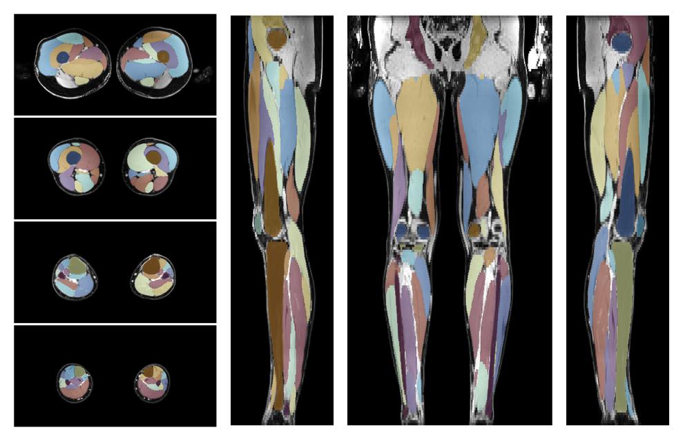 Overlay of automated muscle segmentation labels on dixon water image.